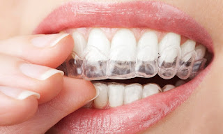 Phương pháp niềng răng invisalign – Hiệu quả thật bất ngờ Gffff