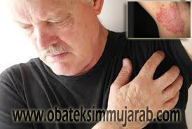 Foto Obat Eksim di Ketiak Yang Manjur