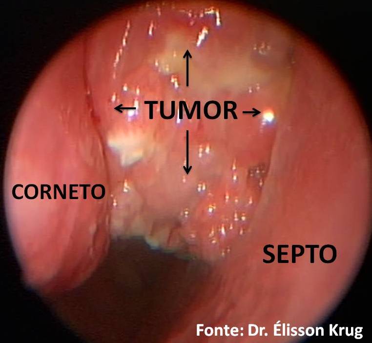 papiloma septo nasal