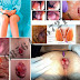 Obat Wasir (Hemoroid) Ambeien BPOM thumbnail