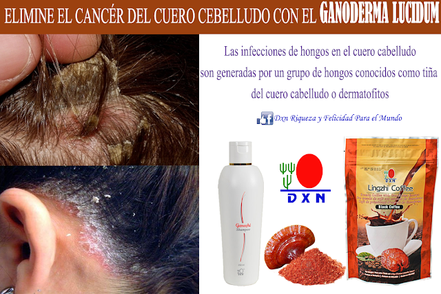 hongo tiña del cuero cabelludo hongo tiña del cuero cabelludo
