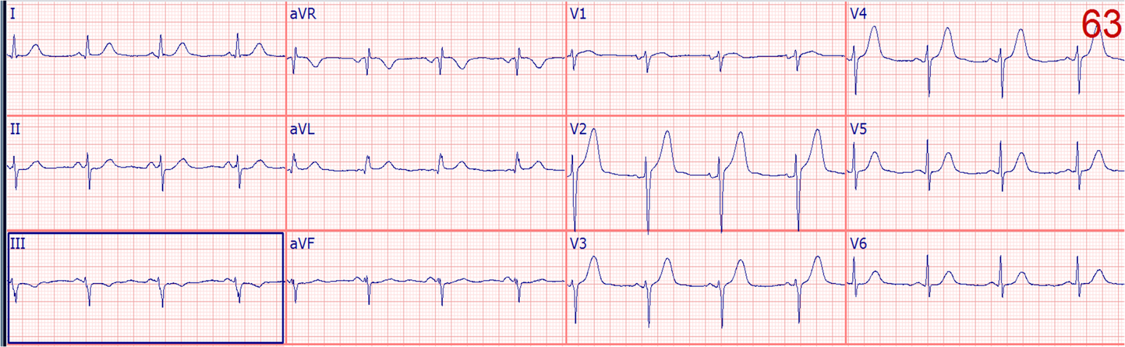 Dr Smith S Ecg Blog Ten 10 Examples Of Hyperacute T Waves In Lead V2 A Few In V3 Due To Acute Lad Occlusion