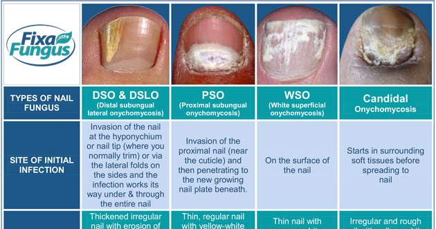 Foot fungus types pictures - Awesome Nail