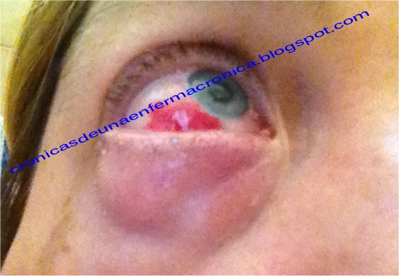 Dolor en el costado de la cabeza y ojo inyectado en sangre Dolor en el costado de la cabeza y ojo inyectado en sangre