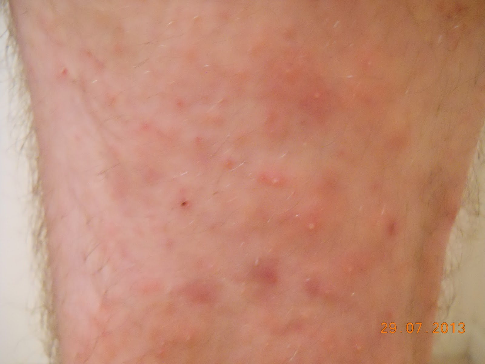 Using Forever Living Products To Take Control Of My Eczema Before Photos