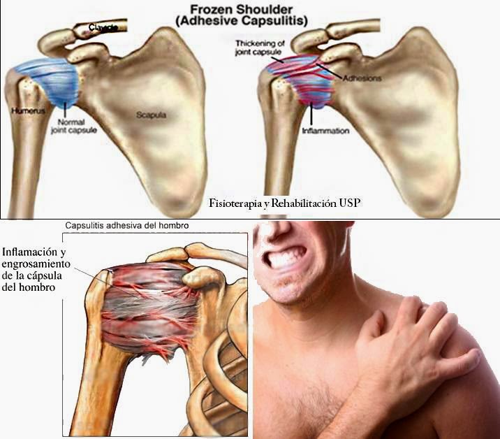 capsulitis de hombro sintomas de diabetes