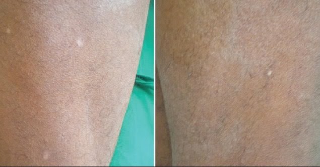 freckles surgery
