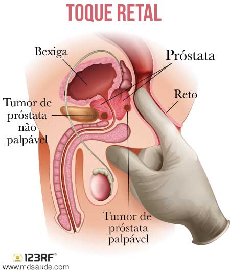 por que te da cancer de prostata
