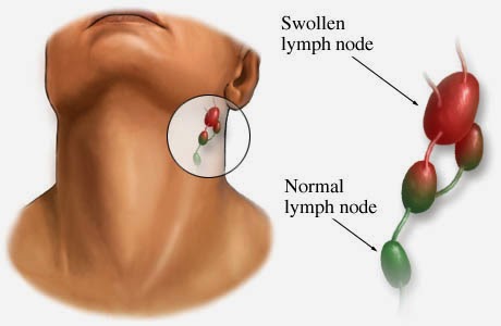cancer pictures of swollen lymph nodes in armpit cancer pictures of swollen lymph nodes in armpit