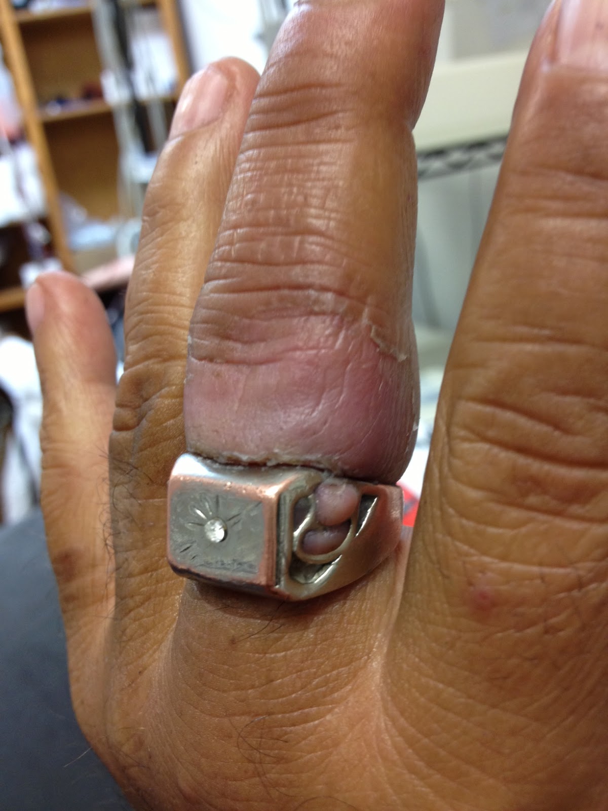 Crossing the Blood Brain Barrier Ringectomy