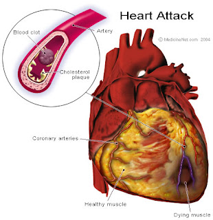 Nursing Assessment for Acute Myocardial Infarction (AMI)