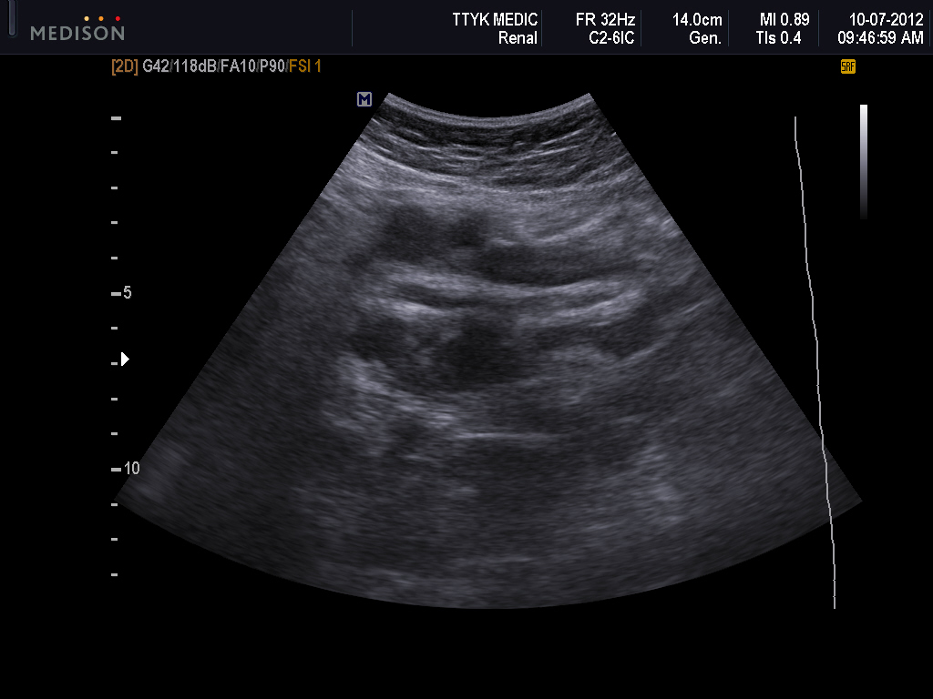 VIETNAMESE MEDIC ULTRASOUND: CASE 131: LEFT SUPRACLAVICULAR NODES
