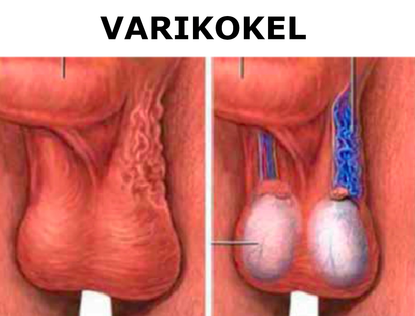 Penyakit Varikokel  Tidak Mematikan HARY HERBAL INDONESIA