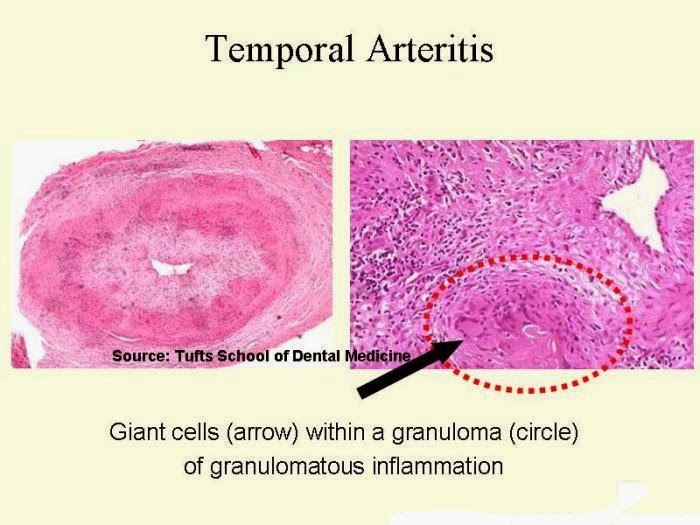 Presentation on the stomach: Giant Cell Arteritis