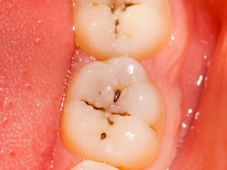 Hàn răng khi bị sâu răng