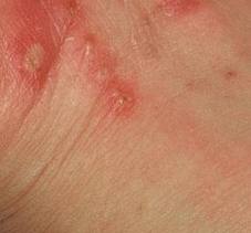 Escabiosis sarna humana imagenes