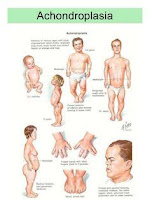 Pengertian Achondroplasia Pengertian Achondroplasia