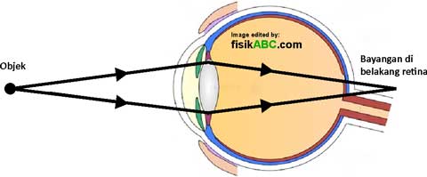 diagram cacat mata hipermetropi (rabun dekat)