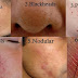 Home Remedies: To Get Rid of Blackheads! In just 2 Weeks Overnight Treatment