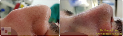 Erkek burun estetiği modelleri - Erkek burun estetiği öncesi ve sonrası - Erkek burun estetiği görüntüleri - Erkek burun estetiği fotoğrafları - Erkek burun estetiği fiyatları - Erkek burun estetiği nasıl olmalı? - Erkeklerde burun estetiği - Erkeklerde rinoplasti operasyonu - Rhinoplasty in men Istanbul - Rhinoplasty for men in Turkey - Male rhinoplasty Istanbul - Nose job in men Istanbul Erkek burun estetiği modelleri - Erkek burun estetiği öncesi ve sonrası - Erkek burun estetiği görüntüleri - Erkek burun estetiği fotoğrafları - Erkek burun estetiği fiyatları - Erkek burun estetiği nasıl olmalı? - Erkeklerde burun estetiği - Erkeklerde rinoplasti operasyonu - Rhinoplasty in men Istanbul - Rhinoplasty for men in Turkey - Male rhinoplasty Istanbul - Nose job in men Istanbul