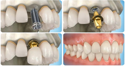 Có nên trồng răng giả ngay sau khi mới nhổ răng?