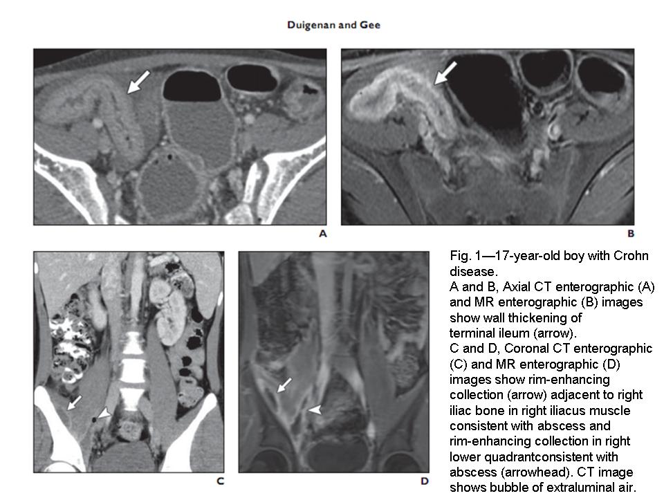 BÀI SOẠN VỀ SIÊU ÂM CHẨN ĐOÁN IBD in Pediatric Patient