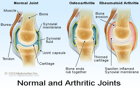 lefogy a rheumatoid arthritis)