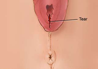 Slide show: Vaginal tears in childbirth - Mayo Clinic
