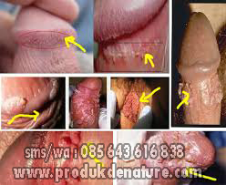 Image Ramuan Khusus Obat Kutil Kelamin – Denature