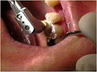 MATERIALES DENTALES FES: RESINAS COMPUESTAS O COMPOSITES 28 29