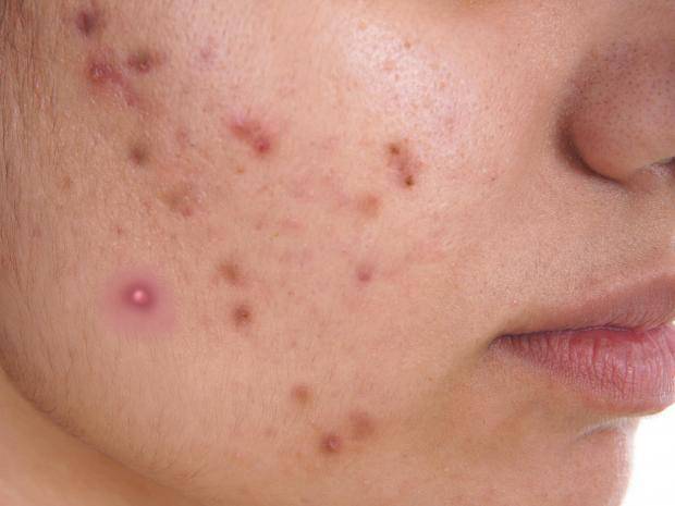 चाहे जैसा हो जख्म का निशान, सिर्फ 2 दिन में यह नुस्खा कर देगा पूरा साफ!