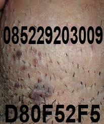 genital warts atau kutil kelamin genital warts atau kutil kelamin