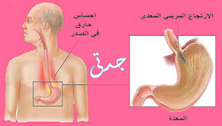علاج ارتجاع المرئ في الطب النبوي علاج ارتجاع المرئ في الطب النبوي
