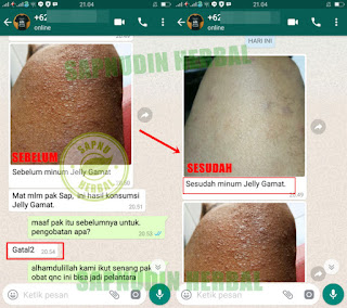 Obat Borok Di Kepala Yang Ampuh Di Apotik 100% Manjur Obat Borok Di Kepala Yang Ampuh Di Apotik 100% Manjur