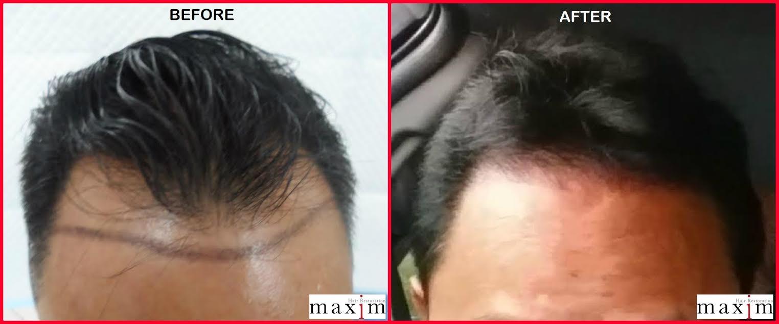 Manila Shopper Hair Loss Is Inevitable But There S A Permanent