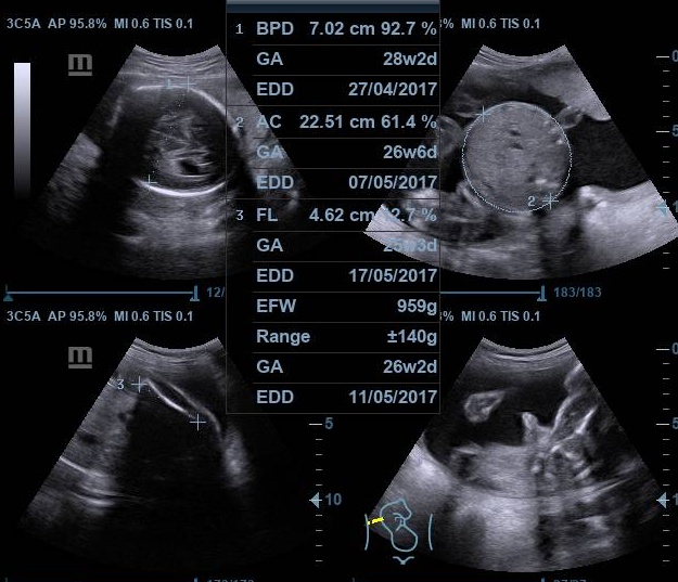 DOKTER KANDUNGAN KU: USG 4 DIMENSI IBU HAMIL