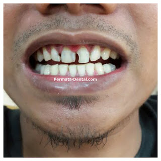 foto, gambar, gigi depan keropos Permata Dental Bali| sebelum dan sesudah gigi keropos diperbaiki di Permata Dental Bali | foto gigi keropos hitam Permata Dental Bali |gigi keropos karena sakit | gigi keropos berlubang | gigi keropos depan| gigi keropos bagian belakang | foto gigi keropos yang sudah diperbaiki Permata Dental Bali |  gigi keropos bagian depan| foto gigi keropos dan patah, foto gigi keropos oleh Permata Dental Bali, Bali Hits, Bali banget, area Bali, Bali kota, area kampus bali. veneer gigi keropos  Bali | veneer gigi keropos badung | veneer gigi keropos nusadua | veneer gigi keropos ngurahrai| veneer gigi keropos denpasar | veneer gigi kropos denpasar kota | veneer gigi keropos Bali | veneer gigi keropos gatsu | |veneer gigi keropos|  depan | veneer gigi keropos  atas | veneer gigi keropos  bawah | veneer gigi keropos  belakang |veneer gigi berlubang bali| veneer gigi berlubang Bali | veneer gigi berlubang nusadua| veneer gigi berlubang ngurahrai| veneer gigi berlubang Badung | veneer gigi berlubang depasar kota | veneer gigi berlubang denpasar| veneer gigi berlubang gatsu| veneer gigi berlubang jimbaran| veneer gigi berlubang bagus Permata Dental Bali | veneer gigi berlubang baik di Permata Dental Bali | veneer gigi berlubang cepat di Permata Dental Bali | veneer gigi berlubang murah di Permata Dental Bali | veneer gigi berlubang aman | veneer gigi berlubang mudah di Permata Dental Bali | veneer gigi berlubang promo Permata Dental Bali | gambar veneer gigi berlubang Permata Dental Bali | gambar sebelum dan sesudah veneer gigi hitam dan berlubang  veneer gigi hitam Bali | veneer gigi hitam Bali | veneer gigi hitam denpasar | veneer gigi hitam jimbaran | veneer gigi hitam nusadua | veneer gigi hitam Bali kota | veneer gigi hitam ngurahrai| veneer gigi hitam badung | veneer gigi hitam gatsu | veneer gigi hitam bagus | veneer gigi hitam baik | veneer gigi hitam cepat di Permata Dental Bali | veneer gigi hitam murah di Permata Dental Bali | veneer gigi hitam aman | veneer gigi hitam mudah di Permata Dental Bali | veneer gigi hitam promo Permata Dental Bali | gambar veneer gigi hitam Permata Dental Bali | gambar sebelum dan sesudah veneer gigi hitam dan berlubang Permata Dental
