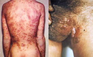 Obat Ampuh Sipilis Obat Ampuh Sipilis