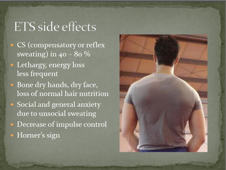 hyperhidrosis surgery cost
