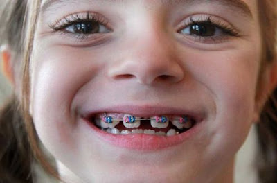 Niềng răng không nhổ răng cho trẻ em nên biết