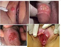 Foto penyakit Sipilis Di Awal Dan Akhir Gejala Foto penyakit Sipilis Di Awal Dan Akhir Gejala