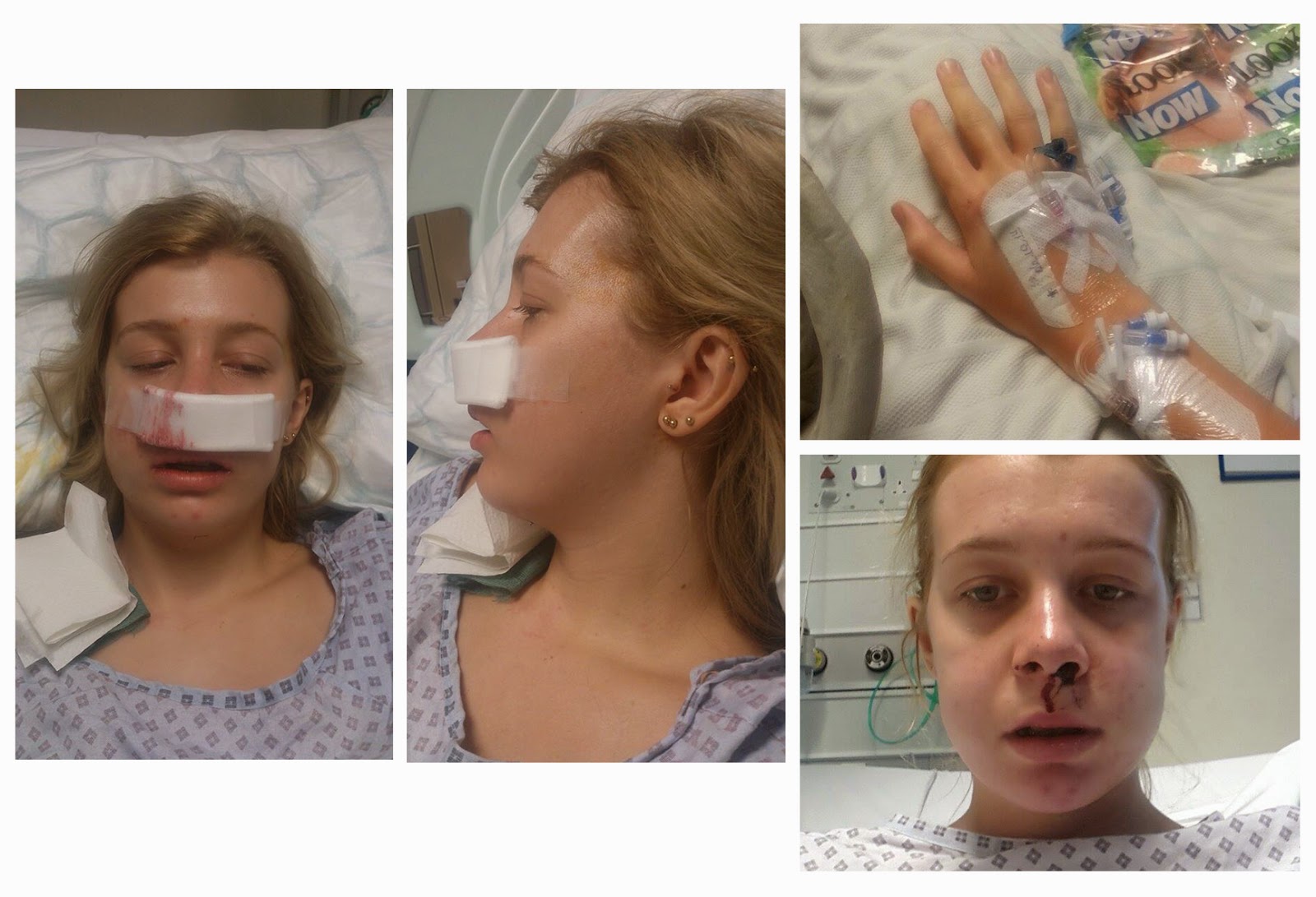 my brace and underbite jaw surgery experience pre and post op underbite surgery