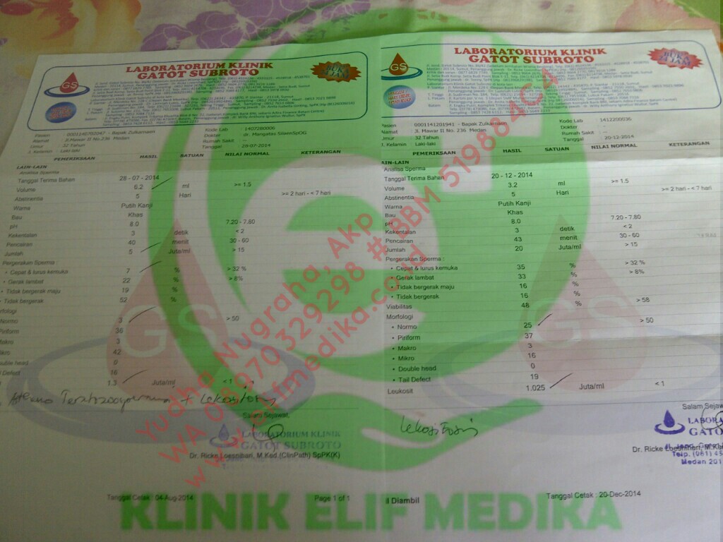 Sebelum pengobatan konsentrasi sperma hanya 5 juta/mil dengan pergerakan sperma cepat hanya 7% dan bentuk sperma normal hanya 3%. Kesimpulan : Oligoasthenoteratozoospermia Sebelum pengobatan konsentrasi sperma hanya 5 juta/mil dengan pergerakan sperma cepat hanya 7% dan bentuk sperma normal hanya 3%. Kesimpulan : Oligoasthenoteratozoospermia