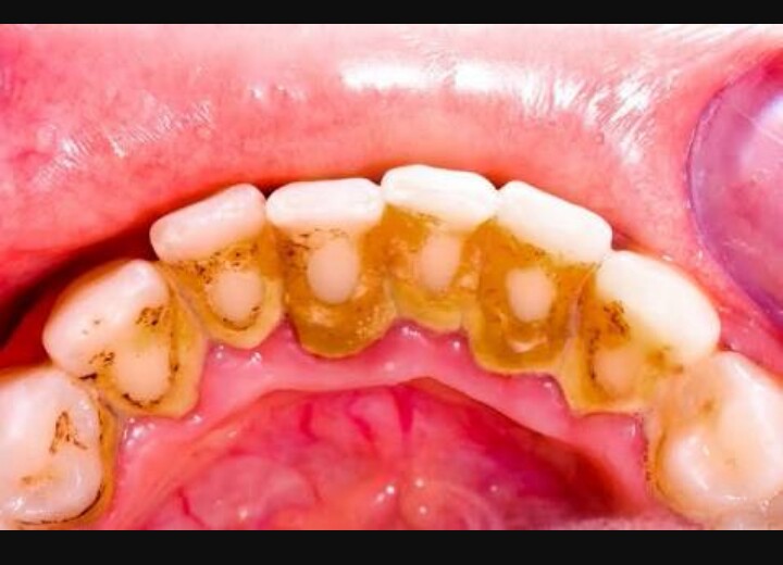 plaque why take care mouth need chidinma inspirations before