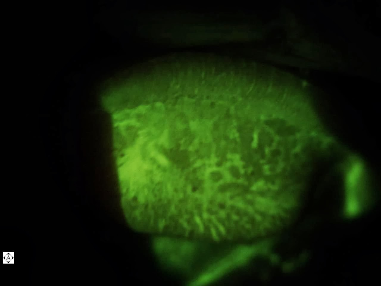 GIANT PAPILLARY CONJUNCTIVITIS (GPC) Sonoran Desert Eye Center