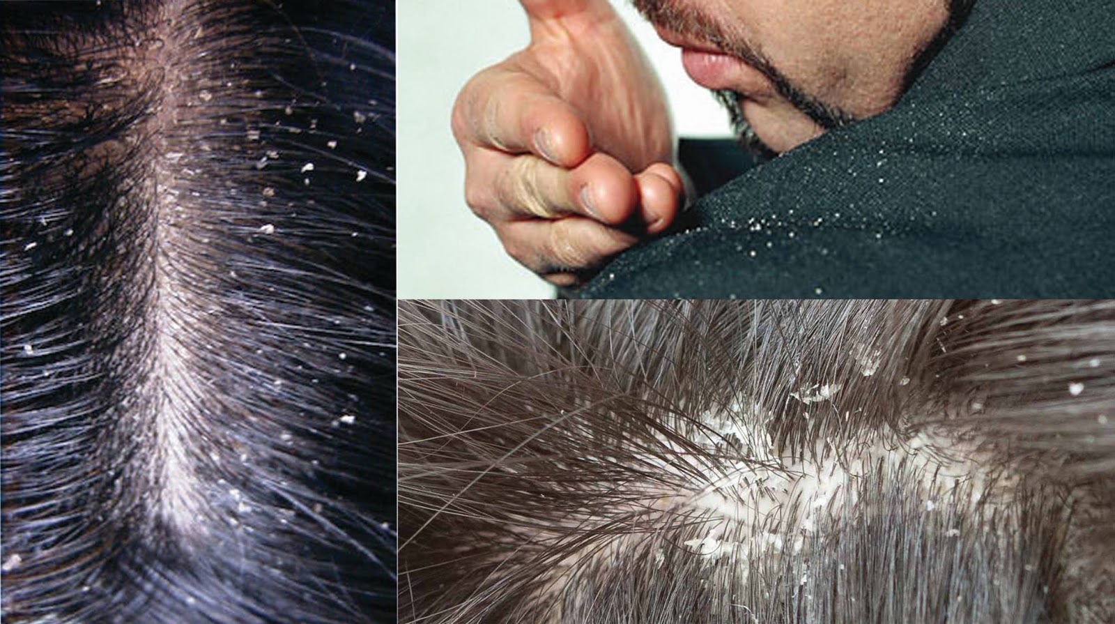 Dandruff Health View