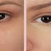 Baking Soda Mask Against Eye Bags, Dark Circles And bloated Eyelids