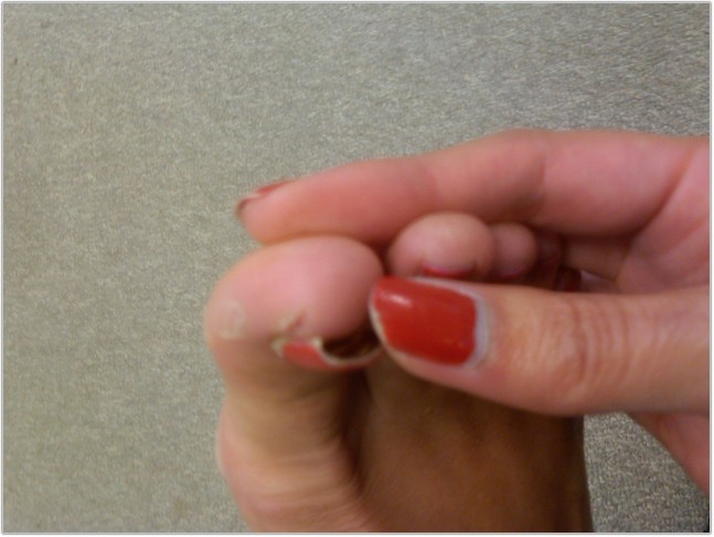 Toe Nail Lifting Nails Magazine Toe Nail Lifting