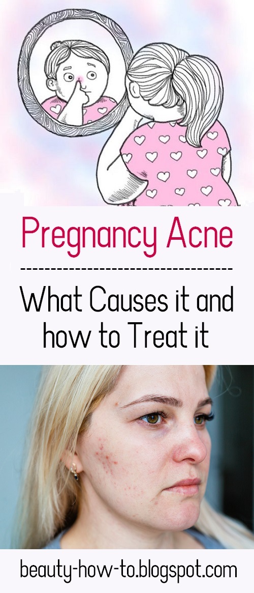 Causes of Pregnancy Acne and How to Treat It How To Beauty