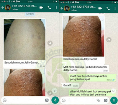 Pengobatan Kulit Bersisik, Kering Dan Gatal (Psoriasis)